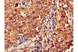 Immunohistochemistry of paraffin-embedded human lung cancer using ABIN7159021 at dilution of 1:100 (MAS1L Antikörper  (AA 318-378))