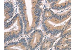 The image on the left is immunohistochemistry of paraffin-embedded Human colon cancer tissue using ABIN7190351(CRIM1 Antibody) at dilution 1/25, on the right is treated with synthetic peptide. (CRIM1 Antikörper)
