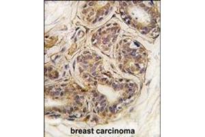 Formalin-fixed and paraffin-embedded human breast carcinoma tissue reacted with CASC3 Antibody  (ABIN391402 and ABIN2837845) , which was peroxidase-conjugated to the secondary antibody, followed by DAB staining. (CASC3 Antikörper  (AA 159-188))