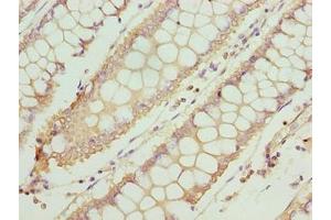 Immunohistochemistry of paraffin-embedded human colon cancer using ABIN7171923 at dilution of 1:100 (TTC30A Antikörper  (AA 201-500))