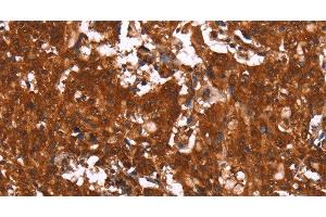 Immunohistochemistry of paraffin-embedded Human gasrtic cancer tissue using HCAR2 Polyclonal Antibody at dilution 1:40 (HCAR2 Antikörper)