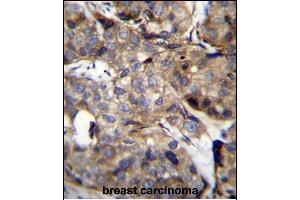 TM4SF1 Antibody (N-term) (ABIN656640 and ABIN2845885) immunohistochemistry analysis in formalin fixed and paraffin embedded human breast carcinoma followed by peroxidase conjugation of the secondary antibody and DAB staining. (TM4SF1 Antikörper  (N-Term))