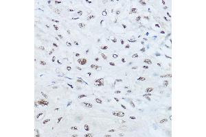 Immunohistochemistry of paraffin-embedded human esophageal cancer using SRRM1 Rabbit pAb (ABIN6133184, ABIN6148463, ABIN6148464 and ABIN6221692) at dilution of 1:450 (40x lens). (SRRM1 Antikörper  (AA 1-160))