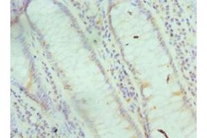 Immunohistochemistry of paraffin-embedded human colon cancer using ABIN7153696 at dilution of 1:100 (FABP6 Antikörper  (AA 1-128))