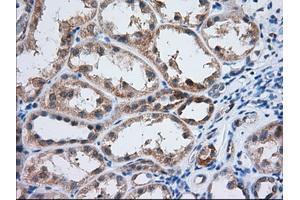 Immunohistochemical staining of paraffin-embedded Adenocarcinoma of Human ovary tissue using anti-IGF2BP2 mouse monoclonal antibody.