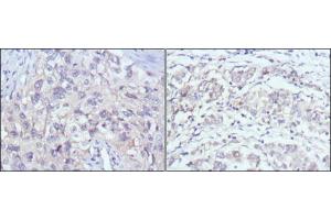 Immunohistochemical analysis of paraffin-embedded human lung cancer (left) and gastric cancer (right) using PAK2 mouse mAb with DAB staining. (PAK2 Antikörper)