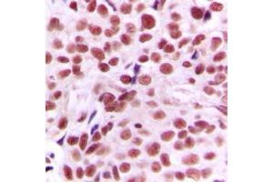 Immunohistochemical analysis of c-Myc staining in human breast cancer formalin fixed paraffin embedded tissue section. (c-MYC Antikörper  (N-Term))