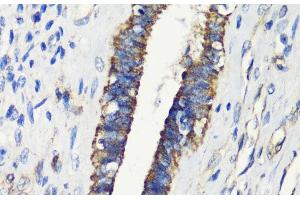 Immunohistochemistry of paraffin-embedded Human uterine cancer using FKBP1A Polyclonal Antibody at dilution of 1:200 (40x lens). (FKBP1A Antikörper)