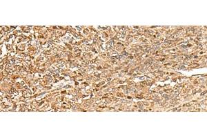 Immunohistochemistry of paraffin-embedded Human liver cancer tissue using ZC3H7A Polyclonal Antibody at dilution of 1:50(x200) (ZC3H7A Antikörper)