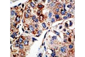 IHC analysis of FFPE human hepatocarcinoma tissue stained with the KMT4 antibody (DOT1L Antikörper  (AA 1390-1420))