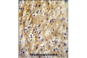HABP2 Antibody (C-term) (ABIN651853 and ABIN2840423) immunohistochemistry analysis in formalin fixed and paraffin embedded human hepatocarcinoma followed by peroxidase conjugation of the secondary antibody and DAB staining. (HABP2 Antikörper  (C-Term))