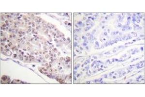 Immunohistochemistry analysis of paraffin-embedded human breast carcinoma tissue, using Histone H4 (Acetyl-Lys8) Antibody. (Histone H4 Antikörper  (acLys8))