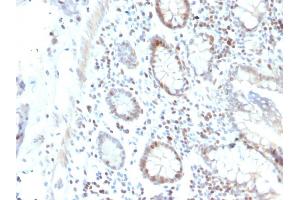 Formalin-fixed, paraffin-embedded human Colon Carcinoma stained with RAD51 Mouse Monoclonal Antibody (RAD51/2702). (RAD51 Antikörper  (AA 1-134))