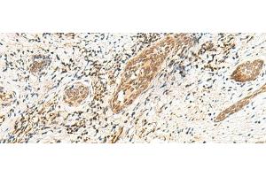 Immunohistochemistry of paraffin-embedded Human esophagus cancer tissue using POLR1D Polyclonal Antibody at dilution of 1:50(x200)