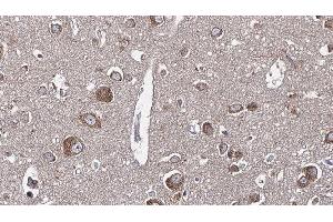 ABIN6277649 at 1/100 staining Human brain cancer tissue by IHC-P. (WNK3 Antikörper  (C-Term))