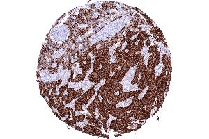 Pancreatic neuroendocrine tumor insulinoma with strong Insulin positivity of most tumor cells (Rekombinanter Insulin Antikörper)