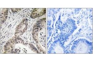 Immunohistochemistry analysis of paraffin-embedded human colon carcinoma, using TUT1 Antibody. (TUT1 Antikörper  (AA 291-340))