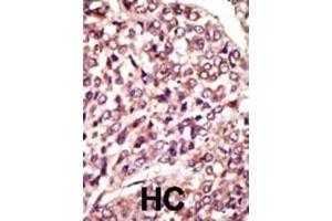 Formalin-fixed and paraffin-embedded human cancer tissue reacted with the primary antibody, which was peroxidase-conjugated to the secondary antibody, followed by AEC staining. (MGAT1 Antikörper  (C-Term))