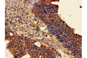 Immunohistochemistry of paraffin-embedded human colon cancer using ABIN7162297 at dilution of 1:100 (ODC1 Antikörper  (AA 1-461))