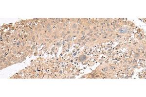 Immunohistochemistry of paraffin-embedded Human cervical cancer tissue using PATJ Polyclonal Antibody at dilution of 1:45(x200) (PATJ Antikörper)