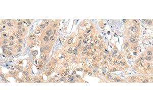 Immunohistochemistry of paraffin-embedded Human esophagus cancer tissue using HIPK2 Polyclonal Antibody at dilution of 1:40(x200) (HIPK2 Antikörper)