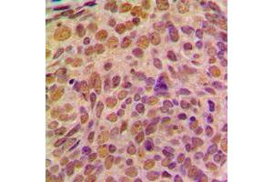 Immunohistochemical analysis of Cyclin B1 staining in human breast cancer formalin fixed paraffin embedded tissue section. (Cyclin B1 Antikörper  (Center))