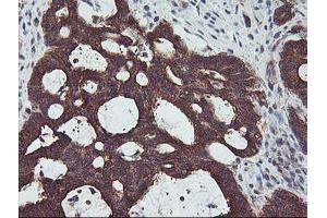 Immunohistochemical staining of paraffin-embedded Adenocarcinoma of Human colon tissue using anti-PDRG1 mouse monoclonal antibody. (PDRG1 Antikörper)