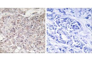 Peptide - +Immunohistochemistry analysis of paraffin-embedded human breast carcinoma tissue using GPRIN3 antibody. (GPRIN3 Antikörper  (Internal Region))