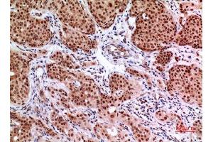 Immunohistochemistry (IHC) analysis of paraffin-embedded Human Mammary Cancer, antibody was diluted at 1:100. (EPAS1 Antikörper  (Ser343))