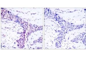 Immunohistochemical analysis of paraffin-embedded human breast carcinoma tissue using ATF-2 (Ab-73 or 55) antibody (E021032). (ATF2 Antikörper)
