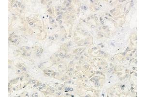 ABIN6263370 and ABIN6279022 at 1/100 staining human renal cell carcinoma by IHC-P. (MRPL37 Antikörper  (N-Term))