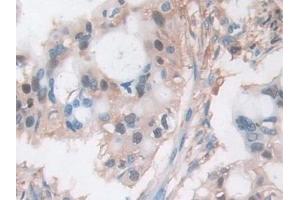 Detection of CFL1 in Human Bile duct cancer Tissue using Polyclonal Antibody to Cofilin 1 (CFL1) (Cofilin Antikörper  (AA 3-161))