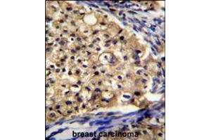 SLC16A13 Antibody immunohistochemistry analysis in formalin fixed and paraffin embedded human breast carcinoma followed by peroxidase conjugation of the secondary antibody and DAB staining.