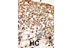 Formalin-fixed and paraffin-embedded human hepatocellular carcinoma tissue reacted with PRKACA polyclonal antibody  , which was peroxidase-conjugated to the secondary antibody, followed by AEC staining .