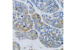 Immunohistochemistry of paraffin-embedded Human esophageal cancer using MBL2 antibody (ABIN6132334, ABIN6143597, ABIN6143600 and ABIN6221519) at dilution of 1:100 (40x lens). (MBL2 Antikörper  (AA 21-248))