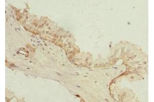 Immunohistochemistry of paraffin-embedded human prostate cancer using ABIN7163670 at dilution of 1:100 (PHLDA2 Antikörper  (AA 1-152))