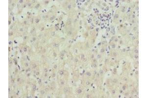 Immunohistochemistry of paraffin-embedded human liver cancer using ABIN7176363 at dilution of 1:100 (ZNF544 Antikörper  (AA 1-230))