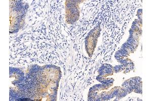 ABIN7094680 and ABIN7098731 at 1/100 staining Human colorectal cancer by IHC-P. (CLCA1 Antikörper  (C-Term))