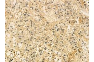 ABIN6259556 and ABIN6274915 at 1/100 staining human hepatocellular carcinoma by IHC-P. (GUSBP2 Antikörper  (Internal Region))