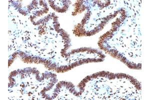 Formalin-fixed, paraffin-embedded human Ovarian Carcinoma stained with SUMO-2 Monoclonal Antibody (SUMO2/1199) (SUMO2 Antikörper)