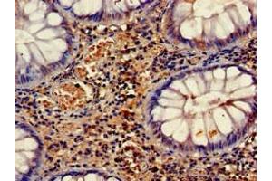 Immunohistochemistry of paraffin-embedded human colon cancer using ABIN7158660 at dilution of 1:100 (HELLS Antikörper  (AA 550-600))