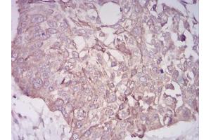 Immunohistochemical analysis of paraffin-embedded esophageal cancer tissues using BMP7 mouse mAb with DAB staining. (BMP7 Antikörper  (AA 239-431))