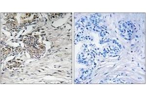Immunohistochemistry analysis of paraffin-embedded human prostate carcinoma tissue, using Claudin 7 (Ab-210) Antibody.