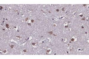 ABIN6275586 at 1/100 staining Human brain cancer tissue by IHC-P. (SLC28A2 Antikörper  (Internal Region))