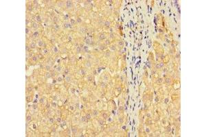 Immunohistochemistry of paraffin-embedded human liver cancer using ABIN7159675 at dilution of 1:100 (METTL7A Antikörper  (AA 30-244))