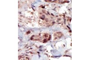 Formalin-fixed and paraffin-embedded human cancer tissue (breast carcinoma) reacted with the primary antibody, which was peroxidase-conjugated to the secondary antibody, followed by AEC staining. (SPHK2 Antikörper  (C-Term))