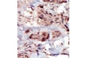 Formalin-fixed and paraffin-embedded human cancer tissue (breast carcinoma) reacted with the primary antibody, which was peroxidase-conjugated to the secondary antibody, followed by AEC staining. (SPHK2 Antikörper  (C-Term))
