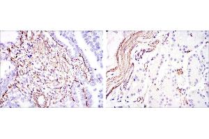 Immunohistochemical analysis of paraffin-embedded stomach cancer (left) and stomach tissues (right) using ACTA2 mouse mAb with DAB staining.