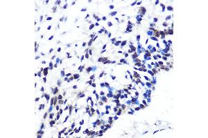 Immunohistochemistry of paraffin-embedded human esophageal cancer using POU2F1/POU2F1/OCT1 Rabbit mAb (ABIN7269495) at dilution of 1:100 (40x lens). (POU2F1 Antikörper)