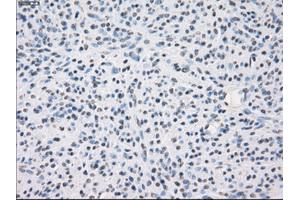 Immunohistochemical staining of paraffin-embedded Carcinoma of thyroid tissue using anti-FCGR2A mouse monoclonal antibody. (FCGR2A Antikörper)